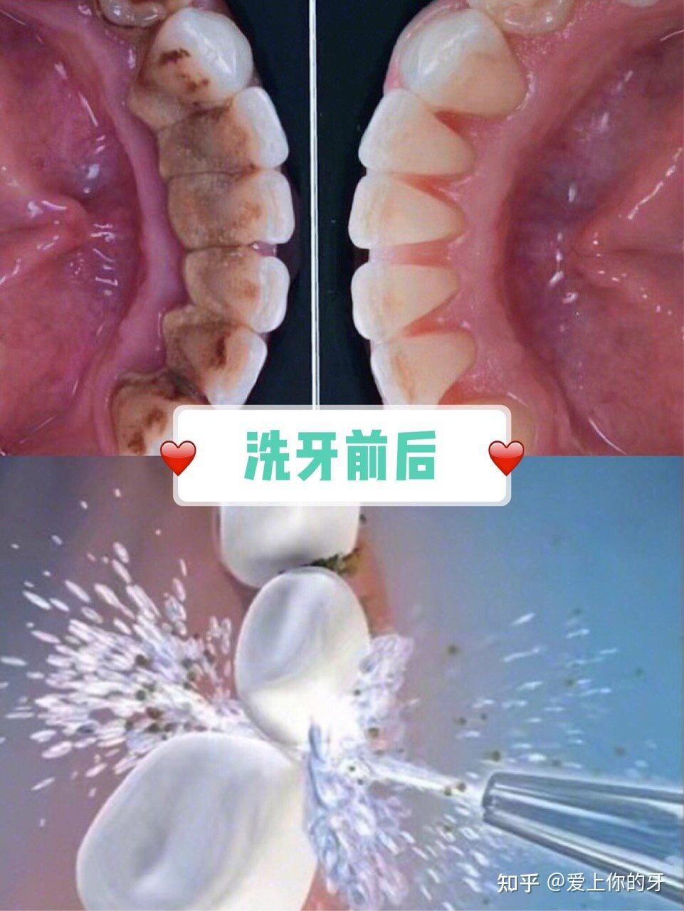 琼海洗牙可以用医保吗(洗牙可以用医保吗,报销比例多少)